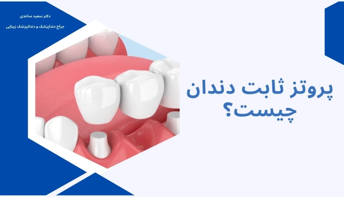 پروتز ثابت دندان چیست؟