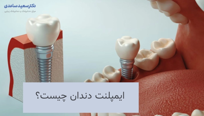 ایمپلنت دندان چیست؟