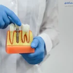 بهترین دکتر ایمپلنت در تهران
