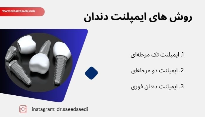روش های ایمپلنت دندان 