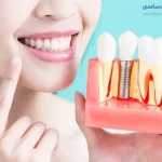 مراقبت های بعد از ایمپلنت دندان