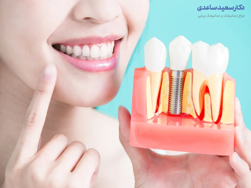 مراقبت های بعد از ایمپلنت دندان