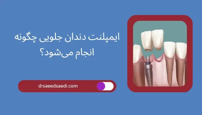 ایمپلنت دندان جلو چگونه انجام می شود