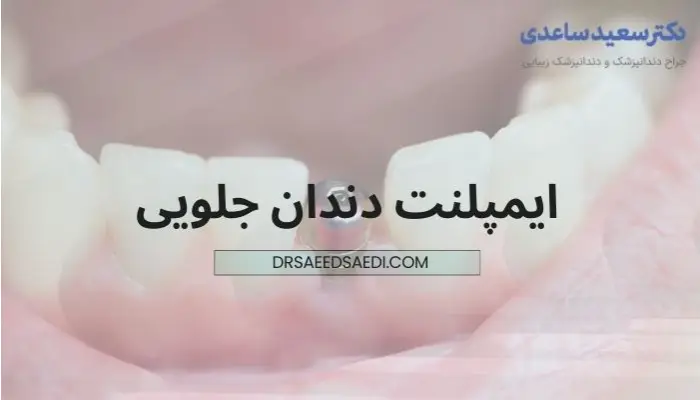 ایمپلنت دندان جلو چیست
