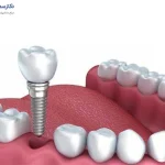 نمونه ای از ایمپلنت دندان عقب