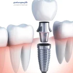 تصویر گرافیکی نمای برش خورده ایمپلنت دندان فوری و اجزای آن