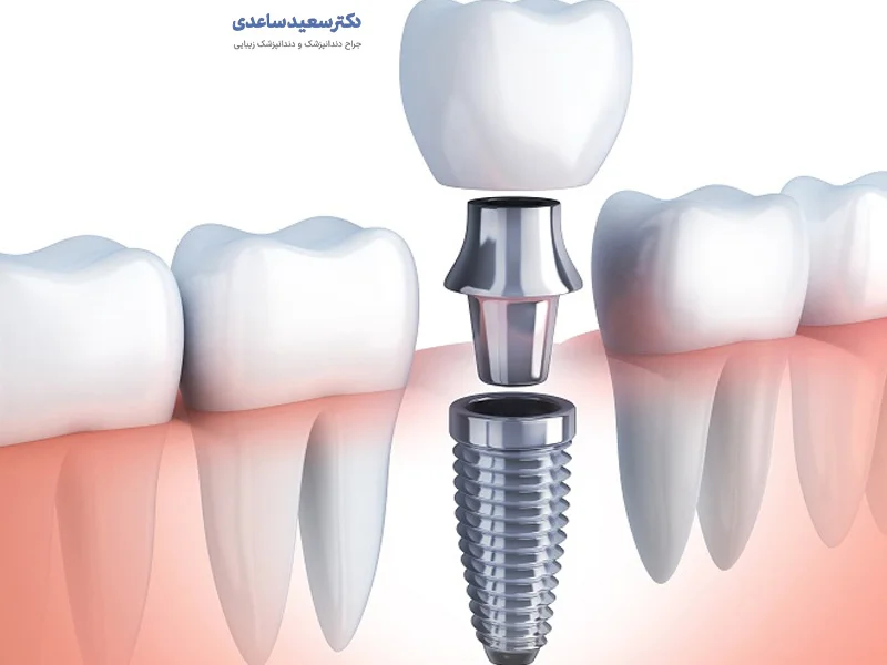 تصویر گرافیکی نمای برش خورده ایمپلنت دندان فوری و اجزای آن