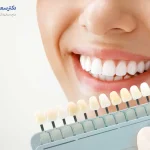 روکش زیرکونیوم