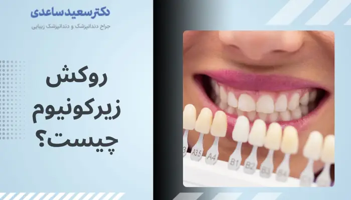 روکش زیرکونیوم چیست؟