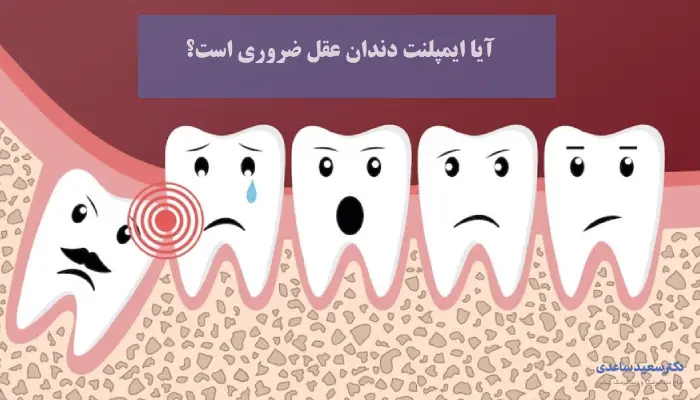 آیا ایمپلنت دندان عقل ضروری است؟