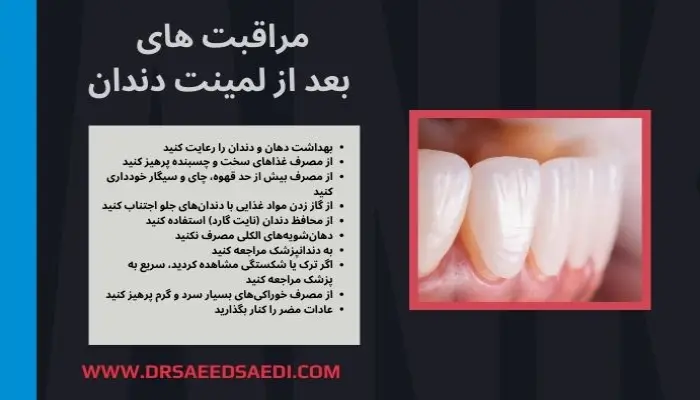 مراقبت های بعد از لمینت دندان چیست