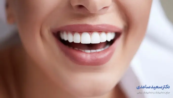 مراقبت پس از لمینت دندان