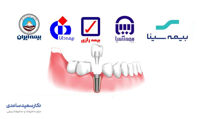 نمایش ایمپلنت دندانی و لوگوهای شرکت‌های بیمه ایرانی نشان دهنده ایمپلنت دندان شامل بیمه میشود؟