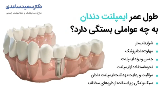 عوامل موثر بر طول عمر ایمپلنت