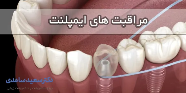 مراقبت های بعد از ایمپلنت