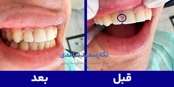 ترمیم دندان با کامپوزیت