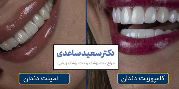 تفاوت لمینت دندان با کامپوزیت دندان