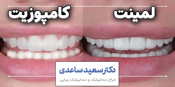 تفاوت لمینت دندان با کامپوزیت دندان