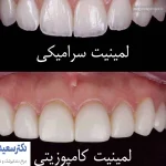 تفاوت لمینت دندان با کامپوزیت دندان