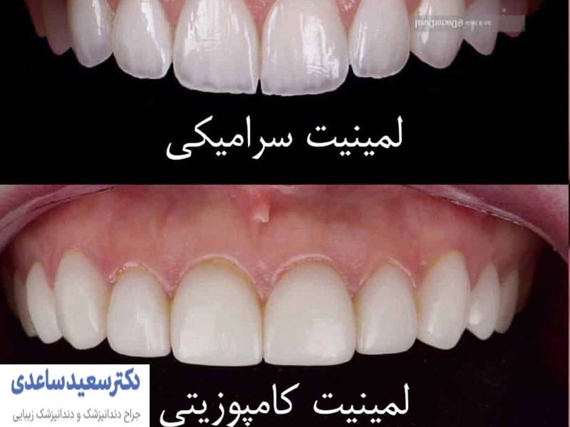 تفاوت لمینت دندان با کامپوزیت دندان