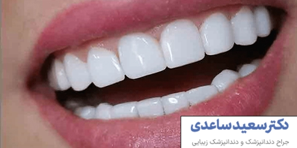 عمر کامپوزیت دندان