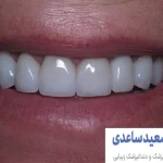 عمر کامپوزیت دندان
