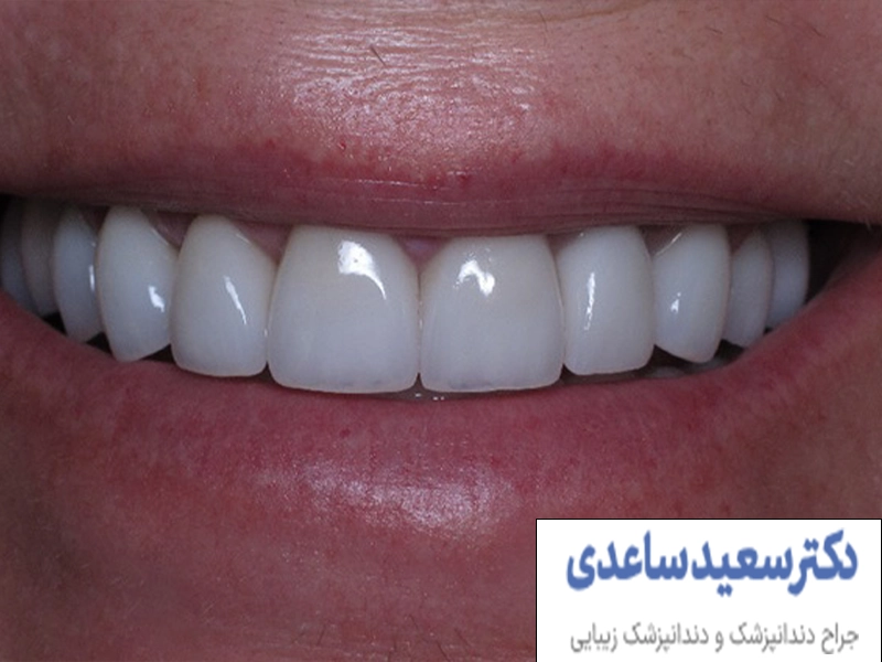 عمر کامپوزیت دندان