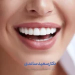 مراقبت قبل از لمینت دندان