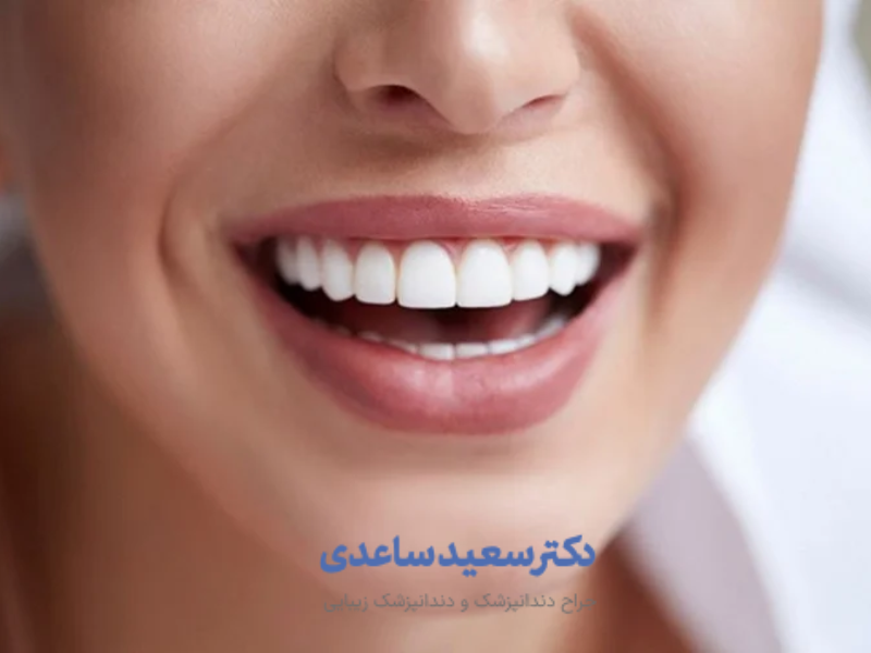 مراقبت قبل از لمینت دندان