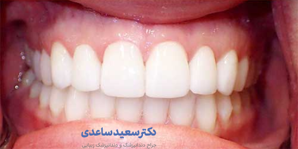 مراقبت قبل از لمینت دندان