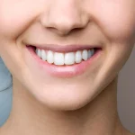 مراقبت های بعد از کامپوزیت دندان