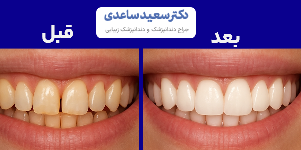 کامپوزیت دندان چیست