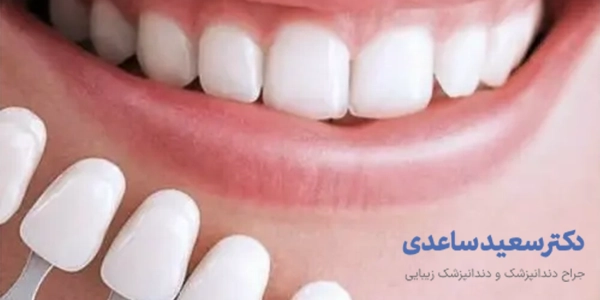 کاندیدای مناسب لمینت دندان