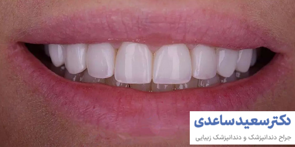 تفاوت ونیر کامپوزیت با بیلیچینگ