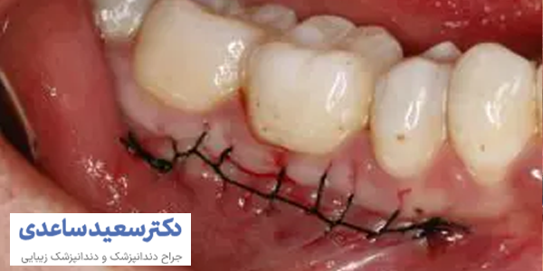 جراحی لثه