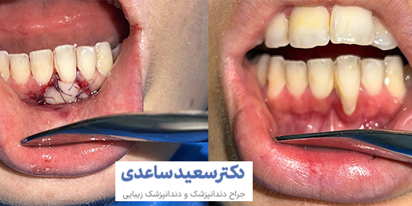 جراحی لثه