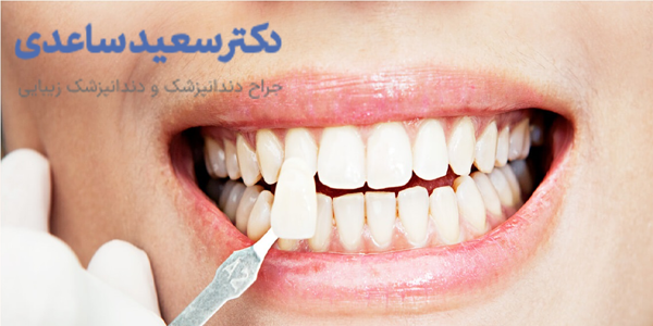 ونیر کامپوزیت