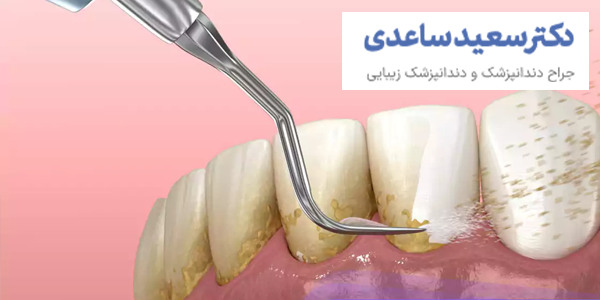 جرم گیری دندان