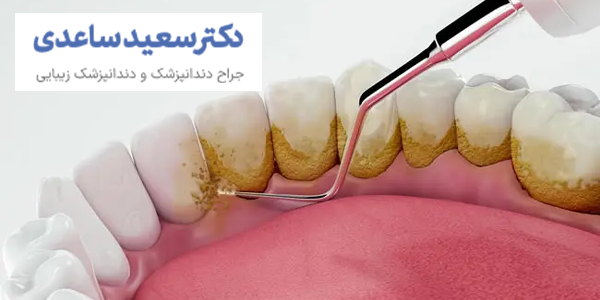 جرم گیری دندان