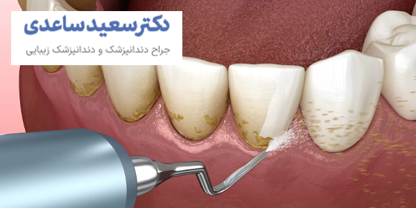 جرم گیری دندان
