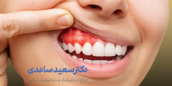 خونریزی لثه