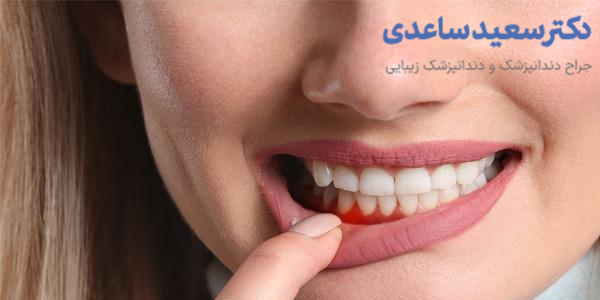خونریزی لثه