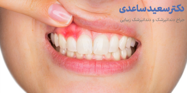 خونریزی لثه