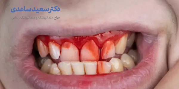 خونریزی لثه
