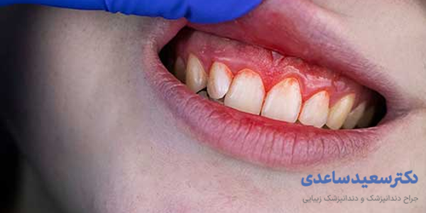 خونریزی لثه