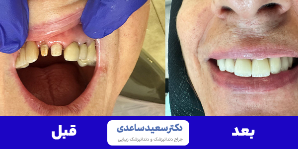 ایمپلنت دندان