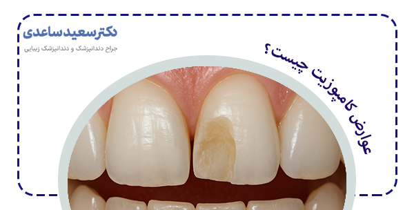 عوارض کامپوزیت چیست
