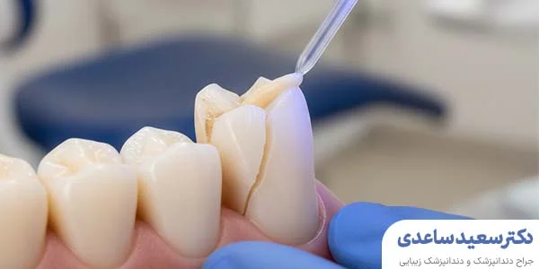 مزایای کامپوزیت دندان جلو