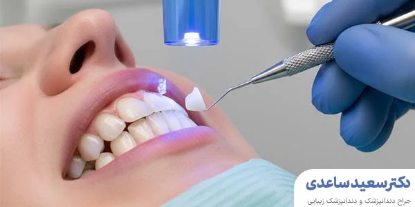 هزینه کامپوزیت دندان جلو