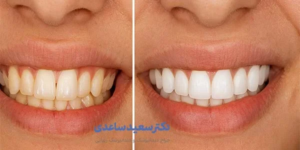 کامپوزیت ندان کامپوزیت چیست